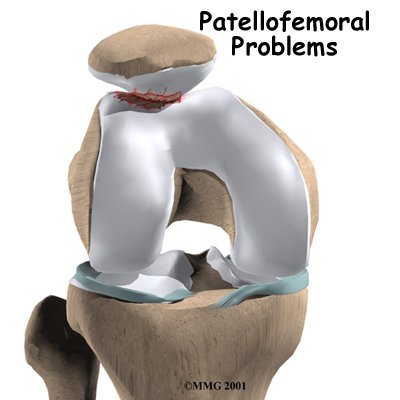 Patellofemoral Problems
