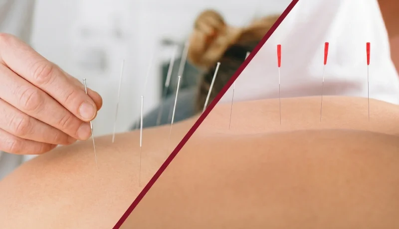 Dry Needling vs. Acupuncture: Key Differences and When to Use Each