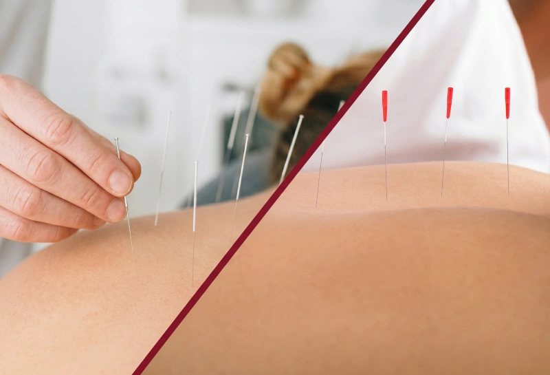 Dry Needling vs. Acupuncture: Key Differences and When to Use Each