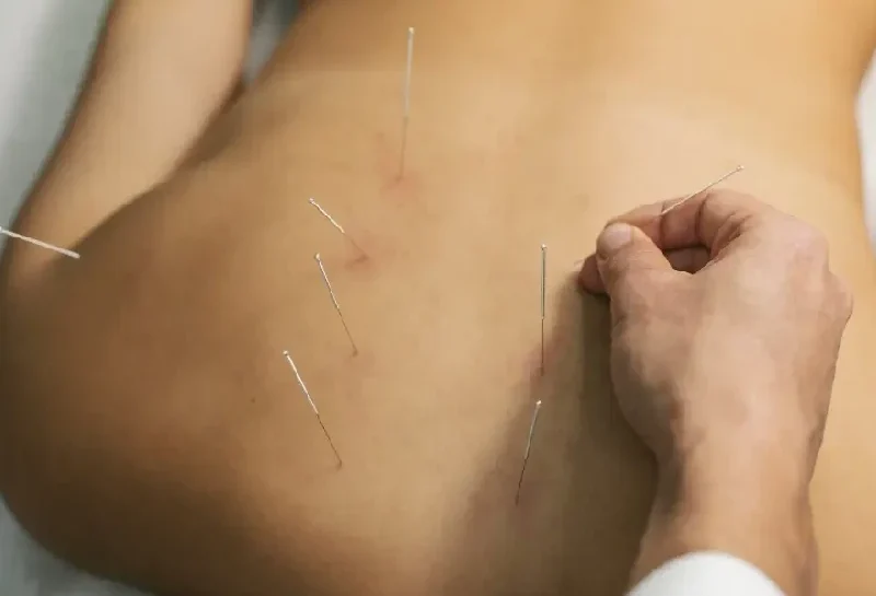 Dry needling physical therapy