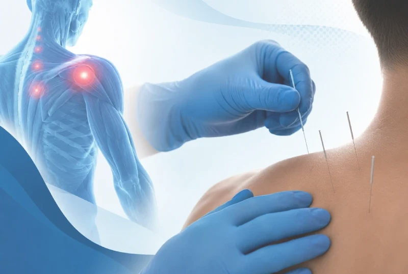 IMS and Dry Needling treatment in Vancouver BC